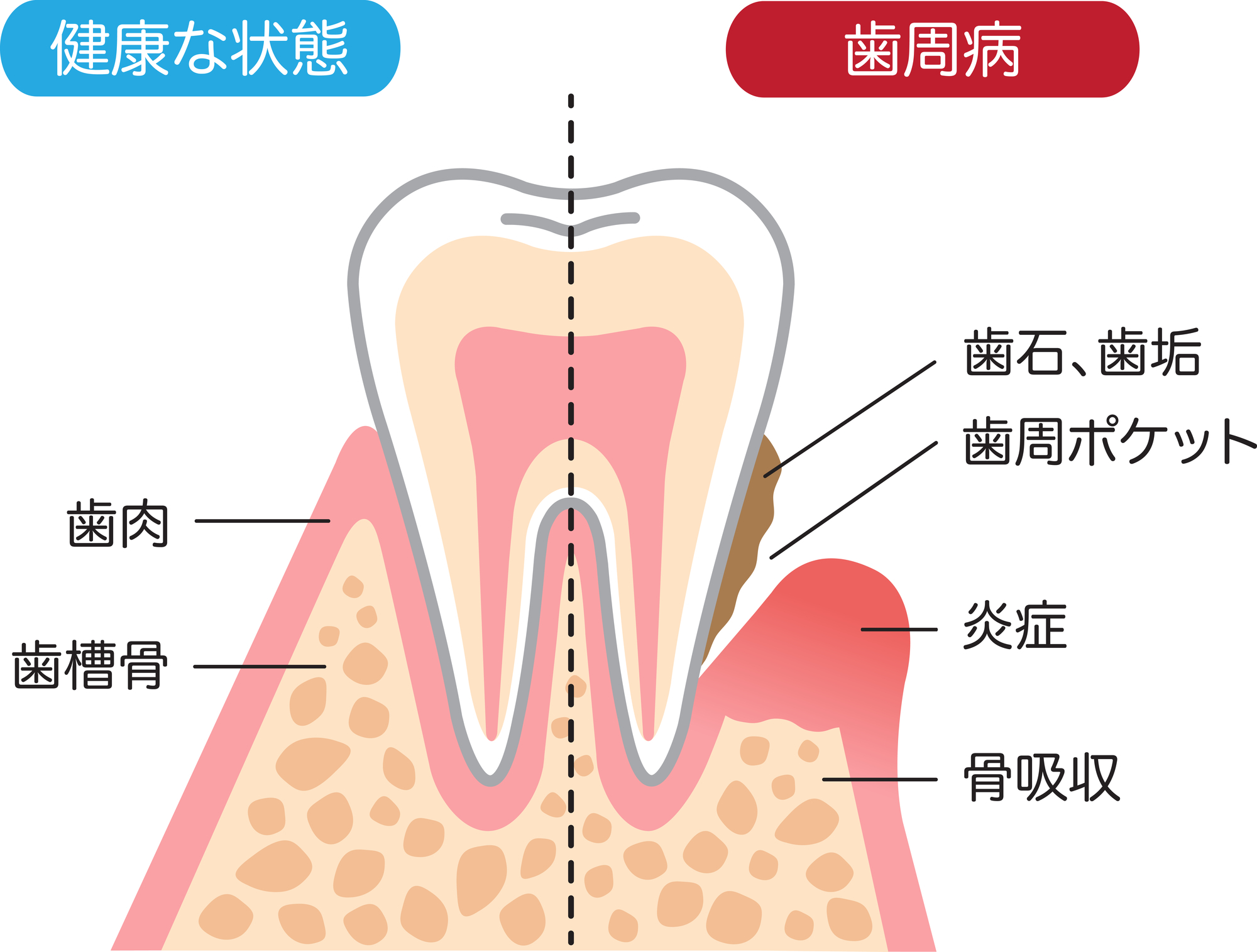 periodontal-disease-illustration